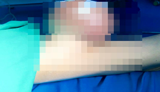 Phẫu thuật cắt thành công khối u nặng 2kg đeo bám người đàn ông suốt 12 năm