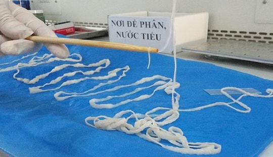 Sán dài 5m làm ổ trong bụng người phụ nữ