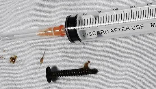 Bé 5 tuổi suýt thủng dạ dày vì nuốt đinh vít dài 3cm
