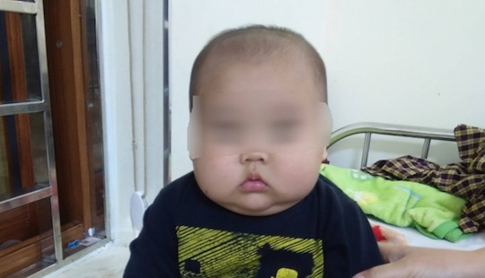 Bé trai 17 tháng bị phù mặt, suy thận do uống thuốc không theo đơn