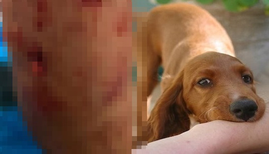 Lại thêm cháu bé 4 tuổi bị chó nhà nuôi cắn nát mặt