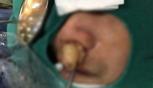 Thủ phạm bất ngờ khiến người đàn ông 10 năm không ngửi được