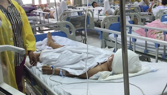 Bé trai bị chó cắn mất 2 tai đang được theo dõi chấn thương sọ não