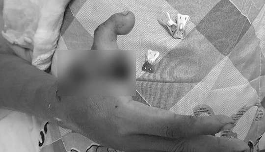 Cắt ngón chân ghép vào bàn tay bị cụt cho nam thanh niên