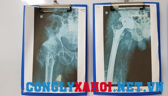 BVĐK Hòa Bình bị tố phẫu thuật chui: Có hành vi gian dối trong việc lập hồ sơ bệnh án
