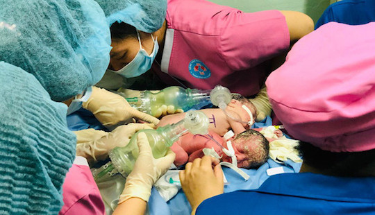 Hy hữu: Cặp song sinh chào đời dính liền nhau, có chung hậu môn