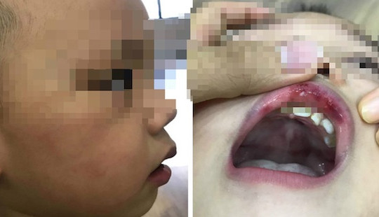 Hà Nội: Bé 3 tuổi bị cô giáo tát bầm mặt, tụ máu môi