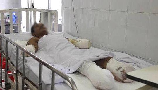 Bị điện giật, 2 công nhân phải cắt cụt tứ chi