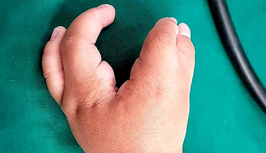 Bé trai 2 tuổi có tay chân dị tật như càng tôm hùm