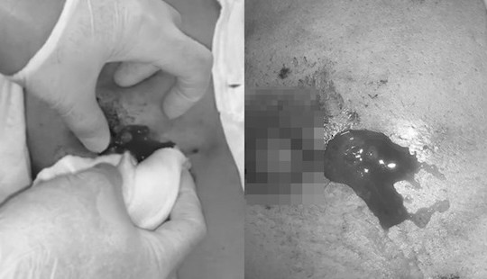 Ngực bị sưng to, chảy dịch mủ sau 4 ngày tiêm filler nâng ngực