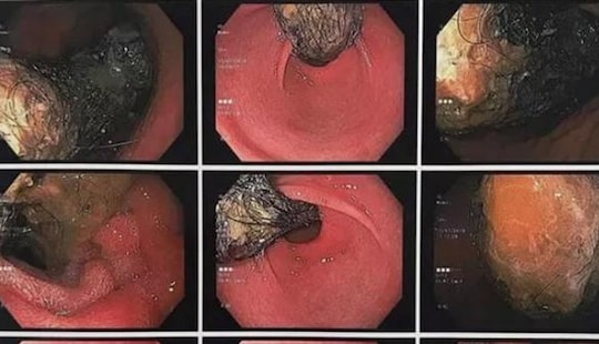 Mắc hội chứng "công chúa tóc mây", bé gái thích ăn tóc của mình
