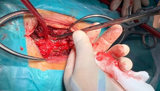 Nam  thanh niên suýt liệt do que xiên thịt đâm xuyên tủy sống