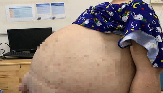 Hút 40 lít nước trong bụng cứu cô gái mang bệnh chỉ 10 người mắc trên thế giới