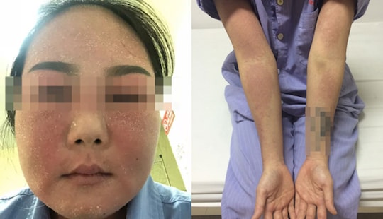 Dùng kem tẩy trắng da tại nhà, 9x phải nhập viện cấp cứu