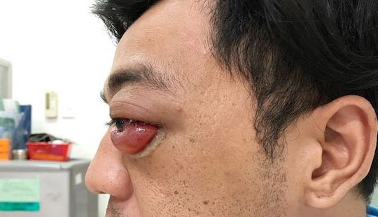 Lồi mắt sau 2 năm bị tai nạn giao thông, người đàn ông suýt bị mù vĩnh viễn