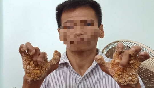 Ghi nhận căn bệnh “người cây” xuất hiện ở Việt Nam