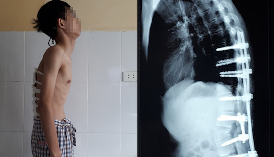 Giải thoát thanh niên 22 tuổi khỏi cảnh gù lưng như cụ ông