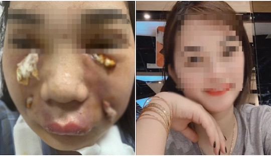 Tiêm mỡ tự thân, cô gái trẻ bị rò mủ, biến dạng mặt