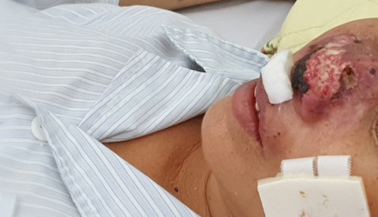 Người phụ nữ bị ăn mòn cánh mũi bởi “vi khuẩn lãng quên”