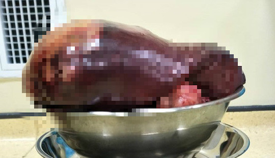 Thanh niên 24 tuổi mang khối u lách 2,3kg, bác sĩ cảnh báo triệu chứng cần kiểm tra ngay
