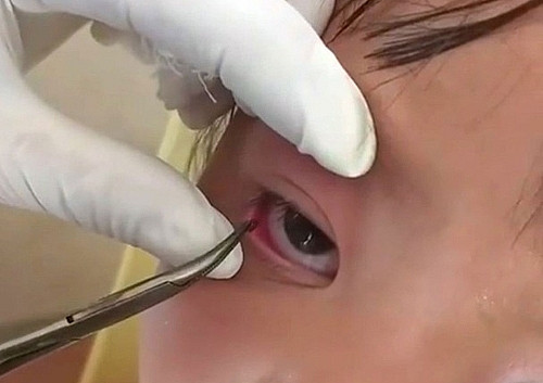 Nghệ An: Gắp bỏ thành công một con vắt trong mắt bé gái người Mông