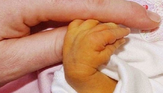 Bé 7 ngày tuổi nguy kịch, phải thay máu vì bố mẹ chủ quan