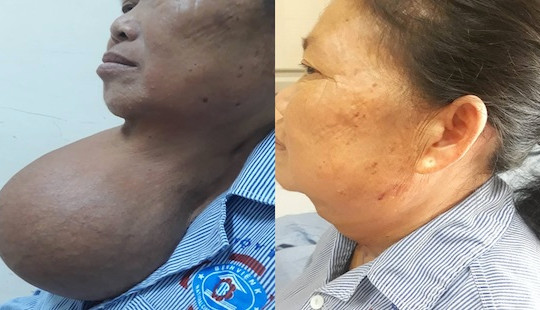 Người phụ nữ mang khối u tuyến giáp 3,2kg suốt 20 năm
