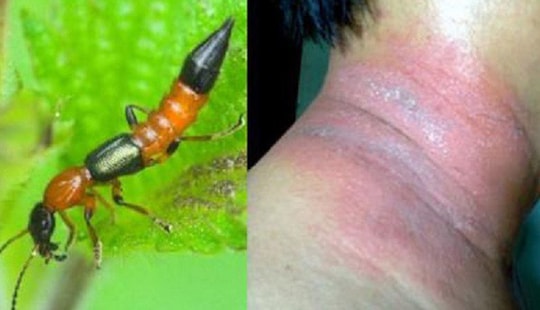 Độc tố kiến ba khoang mạnh gấp 15 lần nọc rắn hổ mang