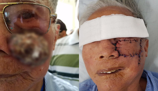 Tự uống thuốc lá chữa khối u, cụ ông 91 tuổi phải khoét bỏ một bên má