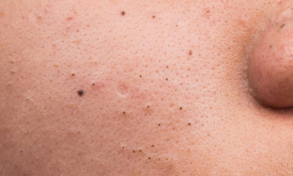 Các loại mụn chắc chắn trong đời bạn sẽ gặp phải