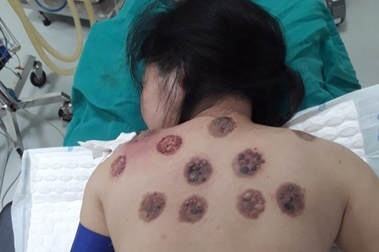Bị hoại tử da, nhiễm trùng vì đi giác hơi