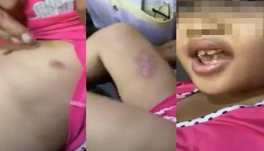 Điều tra vụ bé gái 6 tuổi nghi bị cha dượng dí tàn thuốc lá vào người