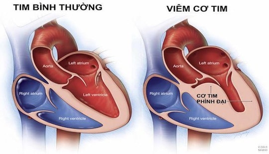 Bộ Y tế chưa ghi nhận chủng "virus lạ gây viêm cơ tim"
