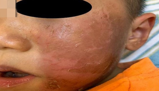Bé 4 tuổi bỏng rộp da mặt vì mặt nạ hóa trang Halloween
