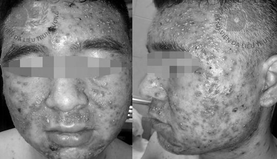 Mua thuốc bôi trên mạng, nam thanh niên bị mụn mủ lan khắp mặt