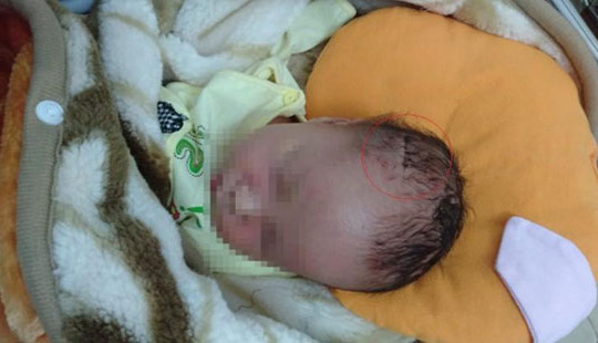 Sơ suất lúc mổ, bé sơ sinh bị dao mổ làm rách da đầu