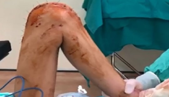 Đau đầu gối kéo dài, nữ sinh 16 tuổi bất ngờ phát hiện ung thư xương
