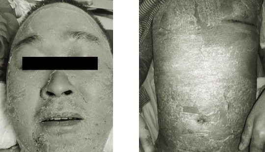 Bong tróc toàn thân do đắp thuốc nam chữa vảy nến