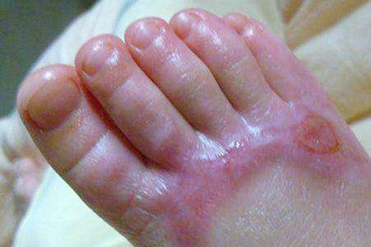 '60 giây vàng' sau khi trẻ bị bỏng, cha mẹ cần làm gì?