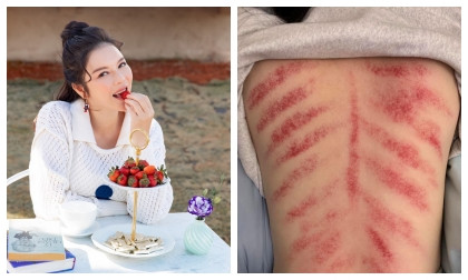Lý Nhã Kỳ đăng ảnh tấm lưng đầy vết đỏ ửng, bạn bè nghệ sĩ đồng loạt lo lắng