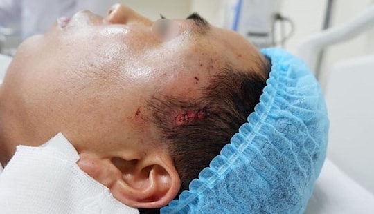 Nhập viện sau khi độn thái dương ở cơ sở thẩm mỹ "chui"