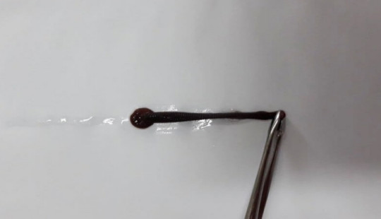 Gắp thành công con đỉa chui vào mũi nữ bệnh nhân