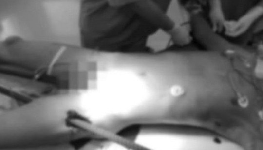 Ngã từ trên cao, nam thanh niên bị 2 cọc sắt đâm xuyên người