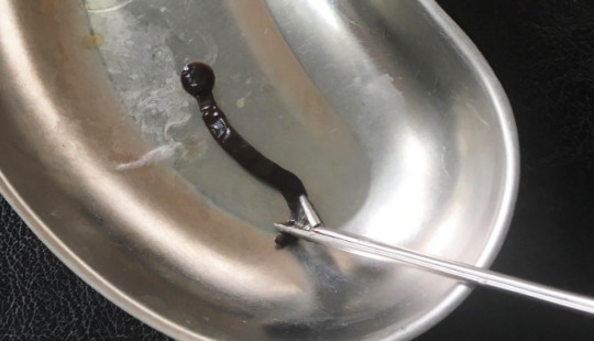 Gắp đỉa nước dài 4cm trong mũi bệnh nhân nhi
