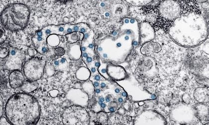 Tìm thấy virus trong tinh dịch người bệnh nhiễm Covid-19