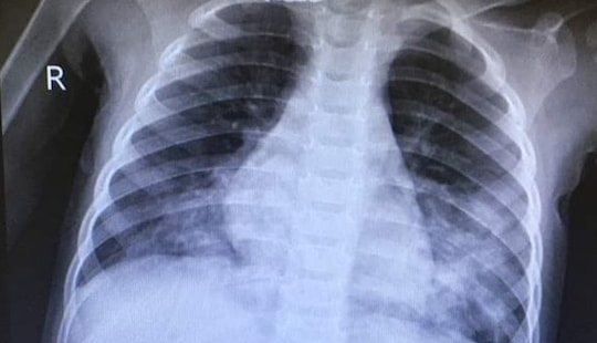 Uống nhầm thuốc tẩy trắng, 2 tuổi xuất huyết tiêu hóa
