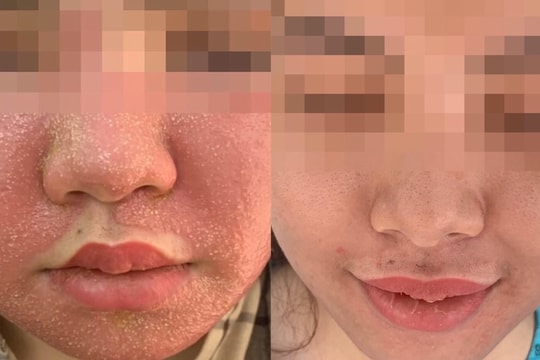 Nhập viện sau đắp mặt nạ đông y làm trắng da