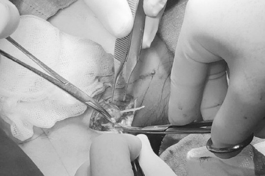 Chữa mắc xương cá theo phương pháp dân gian, bé gái bị nổi u vùng cổ