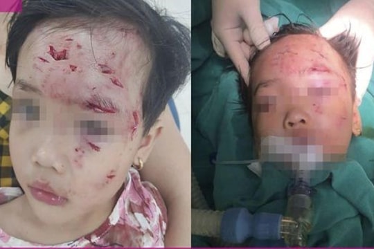 Bé gái 3 tuổi bị chó cắn tổn thương nặng vùng mặt