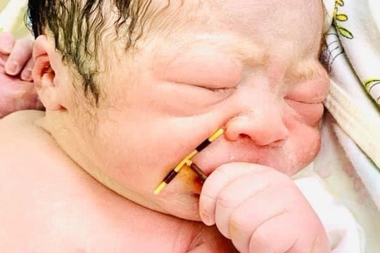 Em bé chào đời tay cầm chặt vòng tránh thai của mẹ
